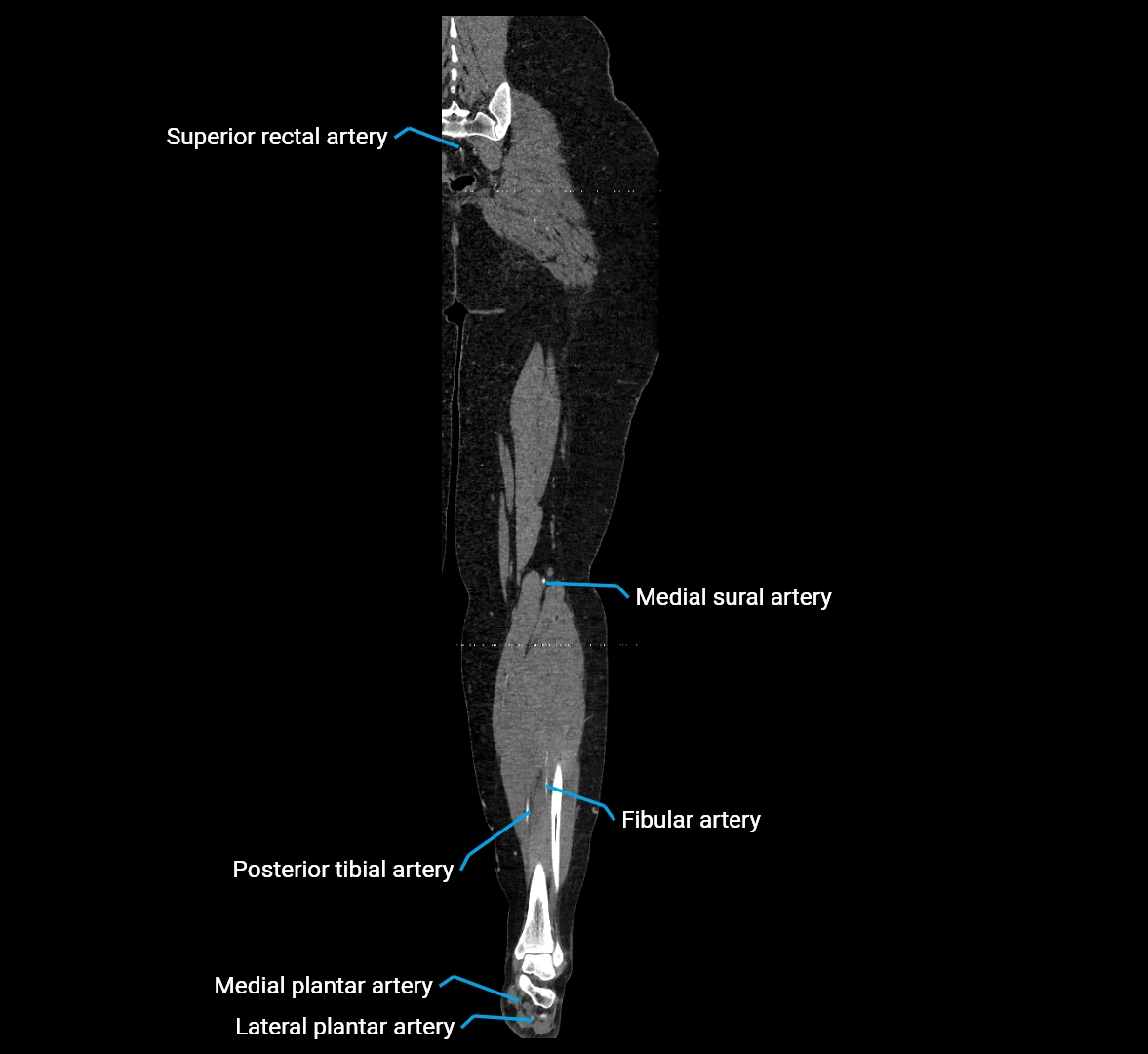 CTA lower limb coronal cross sectional anatomy labelled image _69 (2).webp